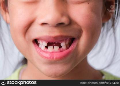 Close-up of a girl with broken upper baby teeth and first permanent teeth. Friendly little girl showing her broken teeth isolated on white background.