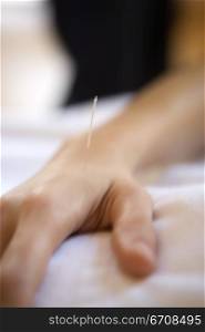 Close-up of a human hand receiving acupuncture treatment