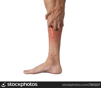 Close up of a man leg with allergy to insect, mosquito, or bug bites isolated on white background. Human organ part