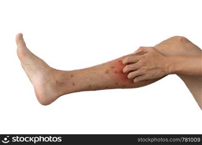 Close up of a man leg with allergy to insect, mosquito, or bug bites isolated on white background. Human organ part