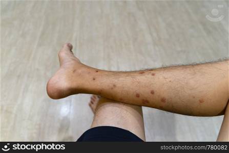 Close up of a man leg with allergy to insect, mosquito, or bug bites isolated. Itchy skin rash. Human organ part.