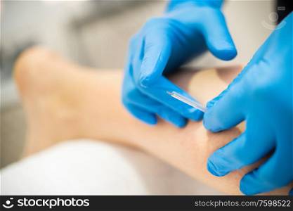 Close-up of a needle and hands of physiotherapist doing a dry needling in a physiotherapy center.. Hands of physiotherapist doing a dry needling