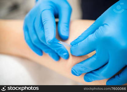 Close-up of a needle and hands of physiotherapist doing a dry needling in a physiotherapy center.. Hands of physiotherapist doing a dry needling