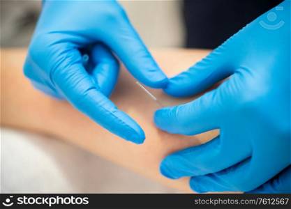 Close-up of a needle and hands of physiotherapist doing a dry needling in a physiotherapy center.. Hands of physiotherapist doing a dry needling