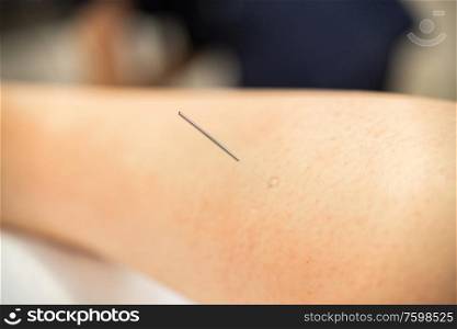 Close-up of a needle doing a dry needling in a physiotherapy center.. Needle of physiotherapist doing a dry needling