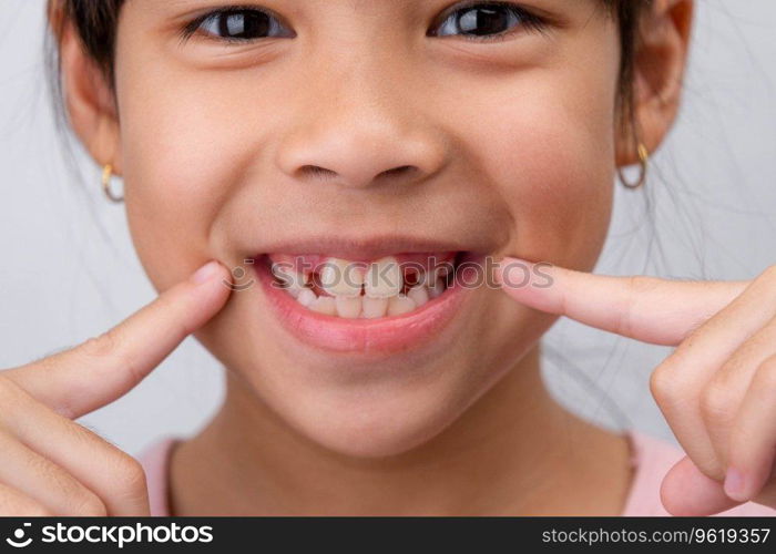 Close-up of cute young girl smiling wide, showing empty space with growing first front teeth. Little girl with big smile and missing milk teeth. Dental hygiene concept