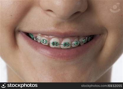 Close up of dental braces in the mouth and on the teeth of a teenage girl
