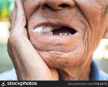Close up of Elderly man biting on cotton gauze after tooth extraction, Tooth decay from not like brushing teeth. Oral care concepts.