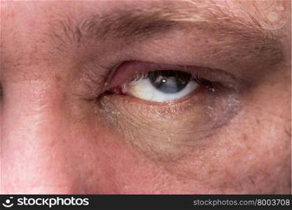 Close up of eye infection with swollen eyelid