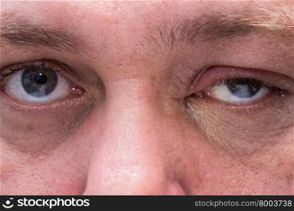 Close up of eye infection with swollen eyelid