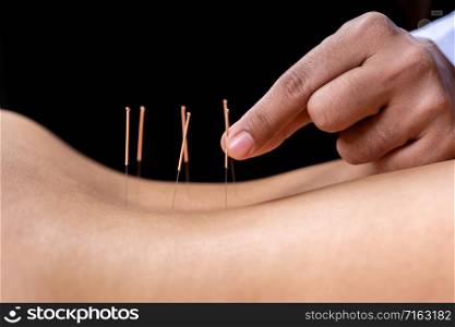 Close-up of female back with steel needles during procedure of the acupuncture therapy