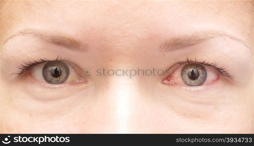 close up of healthy and irritated red eye