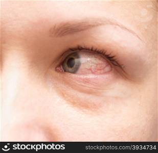 Close up of irritated red bloodshot eye