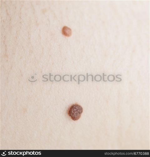 close up of mole on human skin