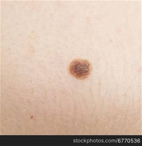 close up of mole on human skin