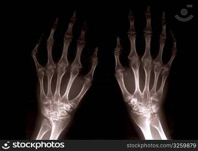 close up of xray hands with black background backlight