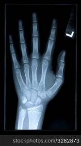Close-up of xray of hand.