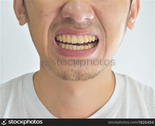 Close-up of yellow dirty teeth in male from smoke and coffee