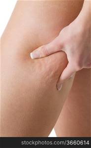 close up on the leg of a girl showing her cellulite