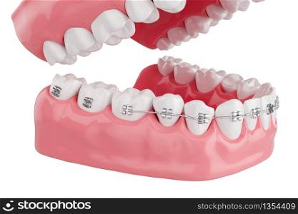 Close up Process Health Teeth with Brace. Selective focus. 3D Render.