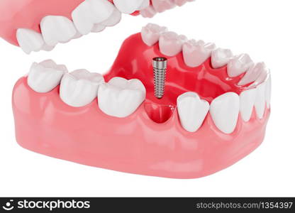 Close up Process Implants teeth health care on white background. Selective focus. 3D Render.