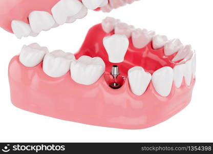 Close up Process Implants teeth health care on white background. Selective focus. 3D Render.