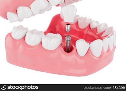 Close up Process Implants teeth health care on white background. Selective focus. 3D Render.