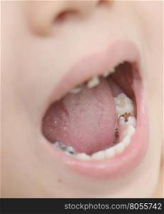 close up shot of baby teeth with caries