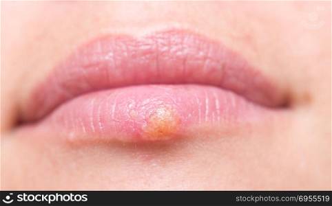 Close up shot of herpes on lips