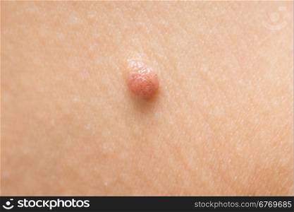 close up shot of mole on human skin