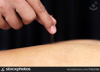 close up therapy of leg with pricking acupuncture needles