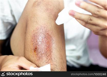 Close-up view of cleaning a bleeding wound under the shin After the accident, traumatic pain, burns.