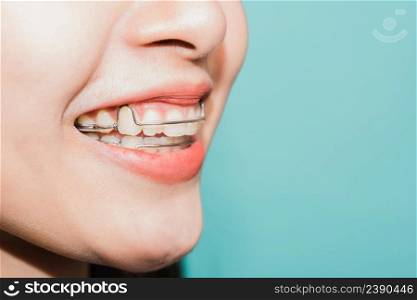 Close up white teeth of young Asian beautiful woman smiling wear silicone orthodontic retainers on teeth isolated on blue background, retaining tools after removable braces. Dental hygiene health