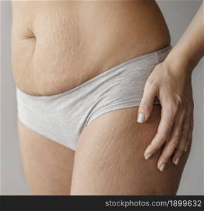 close up woman body with stretch marks. Resolution and high quality beautiful photo. close up woman body with stretch marks. High quality beautiful photo concept