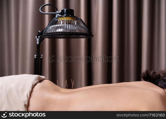 close up woman undergoing acupuncture treatment on back