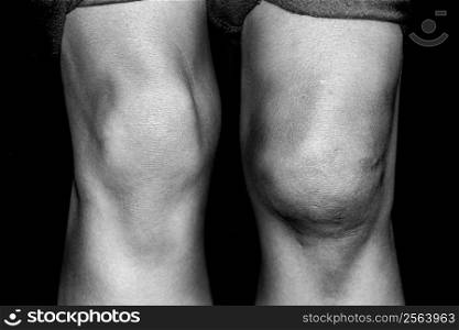 Closeup black and white photograph of an injured knee compared with a normal one