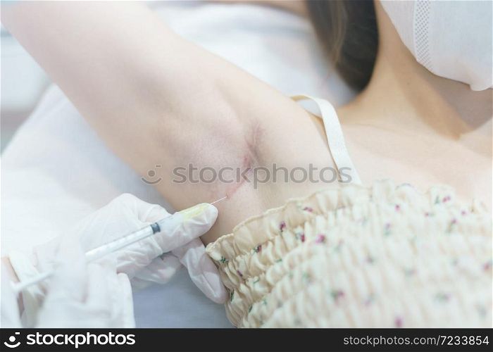 Closeup doctor injection treatment for keloids on the armpit. Keloids from breast surgery.