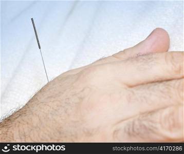Closeup of acupuncture needle inserted in male hand