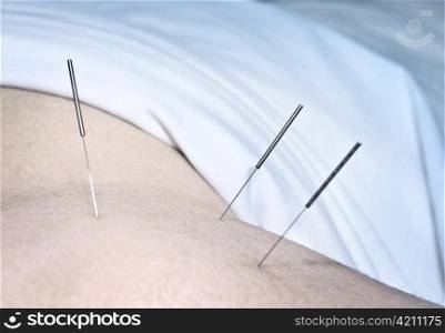 Closeup of acupuncture needles inserted in man&acute;s shoulder
