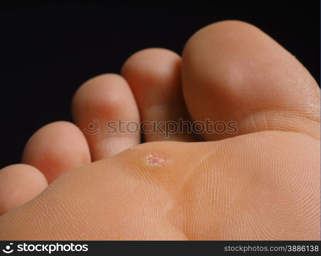 Closeup of foot with a infected wart placed under toes, isolated towards black