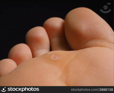 Closeup of foot with a infected wart placed under toes, isolated towards black