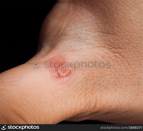 Closeup of injury on hand below thumb isolated towards black backrgound