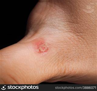 Closeup of injury on hand below thumb isolated towards black backrgound