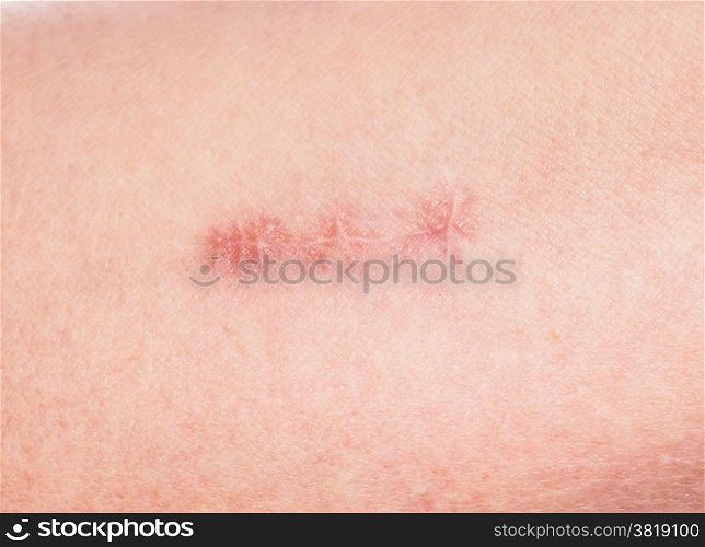 Closeup of redness around healing stitches on skin