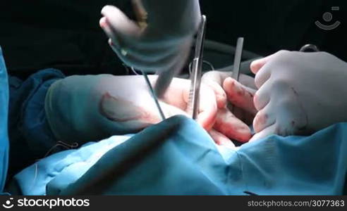 Closeup of surgeon hands placing stitches on patient&acute;s body after successful surgery in operating room. Doctor holding forceps, stitching the patient up.