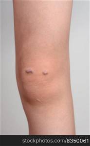 Closeup of the knee of a girl with keloid scar. Knee of a girl with keloid scar