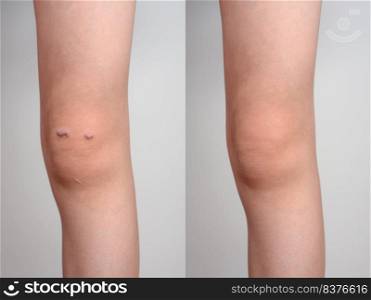 Closeup of the knee of a girl with keloid scar before and after treatment. Knee of a girl with keloid scar, before and after treatment