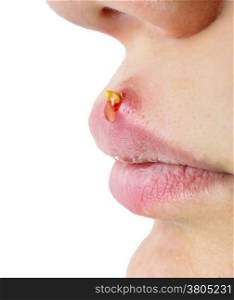Closeup of woman with huge acne outbreak on upper lip