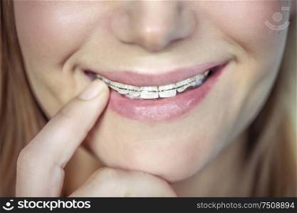 Closeup photo of a beautiful smile of a teen girl with braces, aesthetic dentistry, contemporary fixing of the teeth, health and dental care