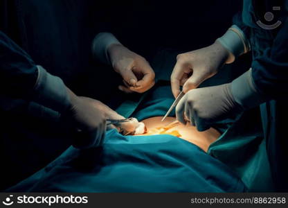 Closeup surgical team performing surgery to patient in sterile operating room. In a surgery room lit by a l&, a professional and confident surgical team provides medical care to unconscious patient.